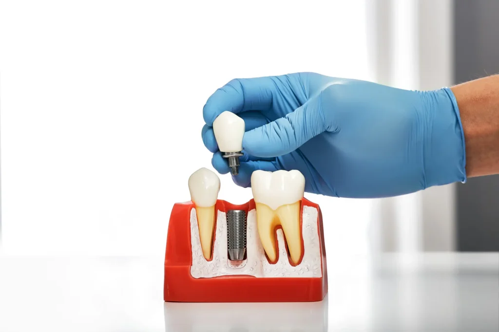 Dental Implants in Aurora: A Permanent Solution for Missing Teeth
