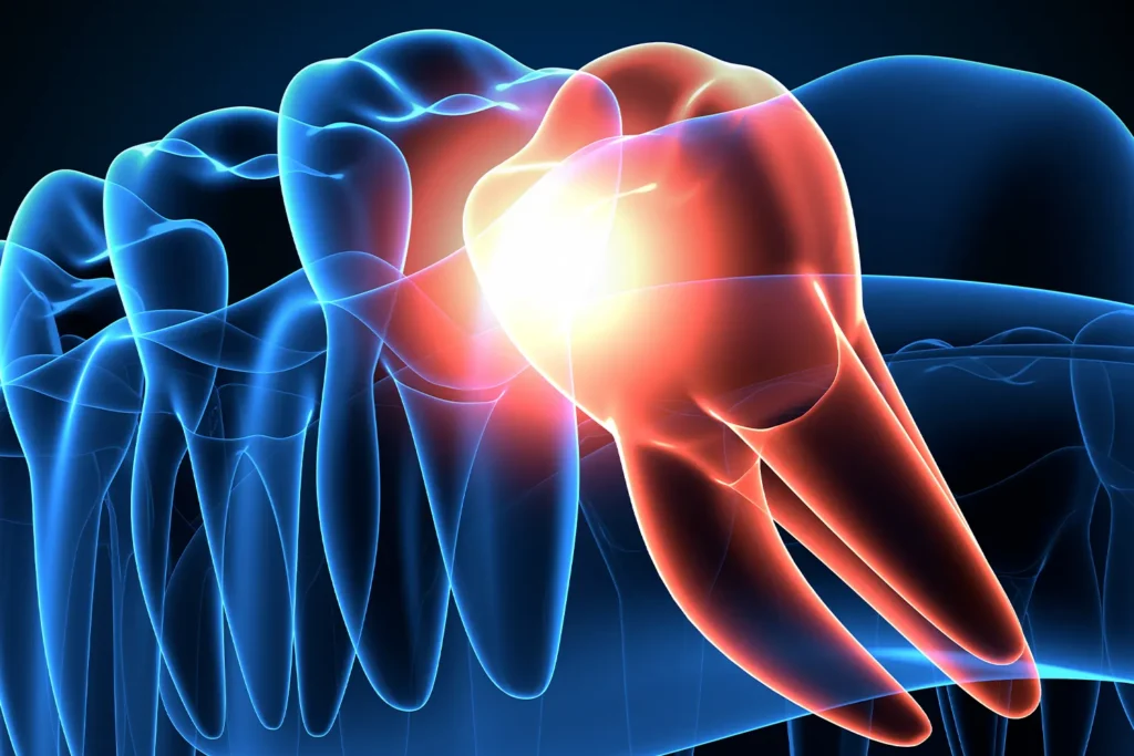 Wisdom Teeth Removal in Aurora: Why Early Intervention is Key