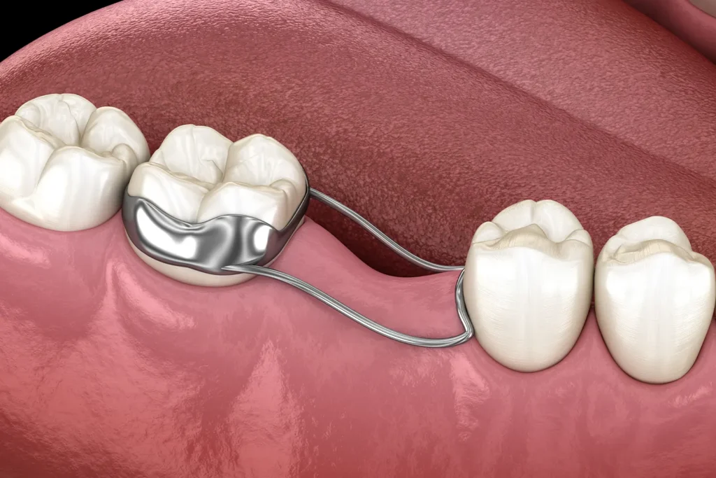 Space Maintainers: Helping Your Child’s Adult Teeth Find Their Proper Place